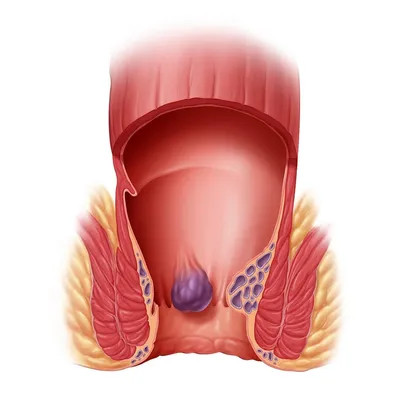 Лечение геморроя у женщин на ранних стадиях в медицинском центре «Я  здоров», цены в Новосибирске
