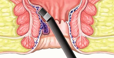 Геморрой: лечение, симптомы, причины, виды профилактика, последствия и  диагностика заболевания