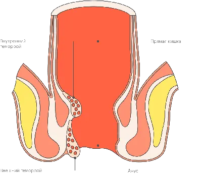 Почему развивается геморрой и как его предотвратить