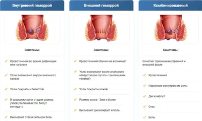 Геморрой, Лечение геморроя в Ташкенте | Клиника Medimax в Ташкенте