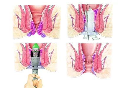 Обезболивание в лечении геморроя