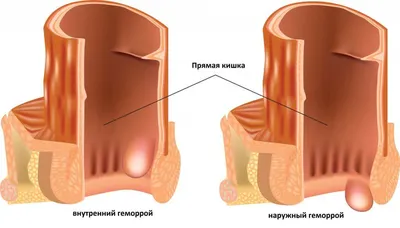 Всем, кто просил для друга. Лечим геморрой | Пикабу