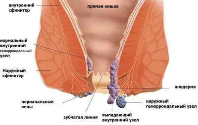 Геморрой: фото, симптомы, в т.ч. при беременности; лечение