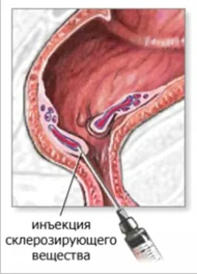 Геморрой лечение и симптомы. Наружный и внутренний геморрой