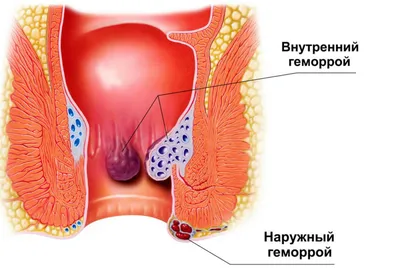 Лечение геморроя в клинике в Челябинске - Клиника «Вся Медицина»