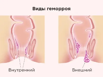 ТОП-14 препаратов от геморроя - рейтинг хороших средств 2021