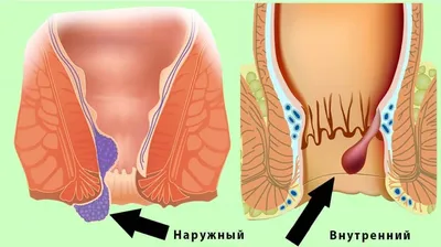 Свечи от геморроя эффективные и недорогие для мужчин и женщин