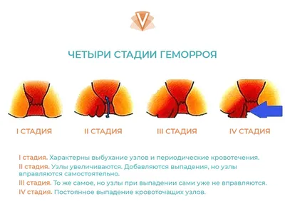 Средства от геморроя - купить, цена, доставка и отзывы, Средства от геморроя  инструкция по применению, дешевые аналоги, описание, заказать в Иркутске с  доставкой на дом - СБЕР ЕАПТЕКА