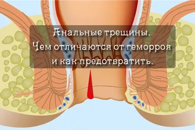 Тромбированный геморрой: причины, диагностика, симптомы и лечение