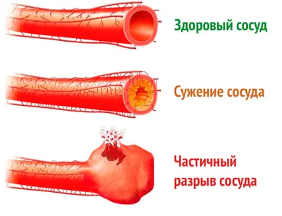 Лазерное лечение геморроя за 1 визит | Услуги клиники ЕВРОПА