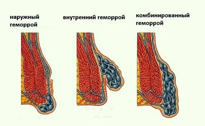 Купить Релиф Ультра, свечи противозудные для лечения геморроя, ректальные,  10 шт., Байер (гидрокортизон+цинка сульфат) по выгодной цене в ближайшей  аптеке. Цена, инструкция на лекарство, препарат