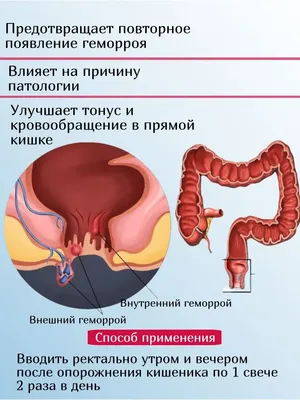 Геморрой: причины, виды, методы лечения и последствия для здоровья