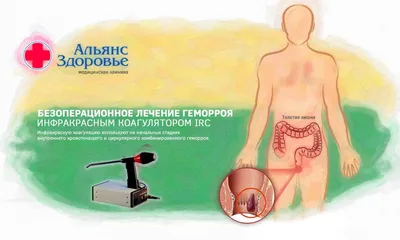Геморрой симптомы, лечение у женщин и мужчин, какие есть средства,  профилактика