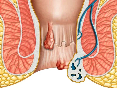 Геморрой: причины, симптомы, стадии, виды, осложнения, профилактика