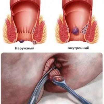 Картинки геморроя фотографии