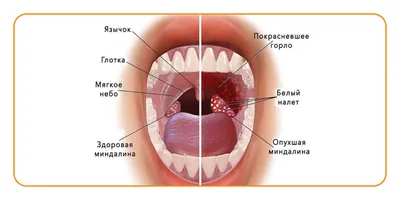 Воспаление горла, лечение, как выглядит, почему воспаляется горло — блог  Фурасол®