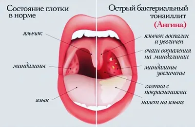 Боль В Горле Во Рту Крупным Планом Заболевания Горла И Слизистой Оболочки  Покраснение Горла И Миндалин — стоковые фотографии и другие картинки Горло  - iStock