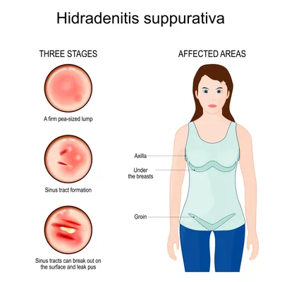 Clinical manifestations of hidradenitis suppurativa (HS) demonstrating... |  Download Scientific Diagram