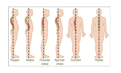 Картинки искривления позвоночника фотографии