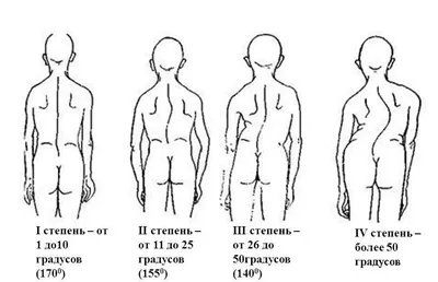 Искривление позвоночника: сколиоз (1 часть) | Доктор Гульнара Мазитова |  Дзен