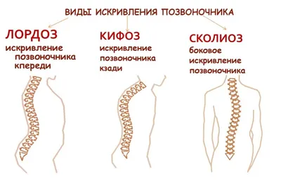 Гимнастика, ЛФК и комплекс лечебных упражнений при сколиозе