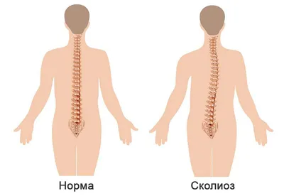 Лечение искривления позвоночника в Одессе - оздоровительный центр  Евминов–Кудряшова