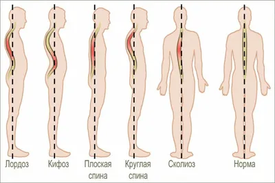 Сколиоз