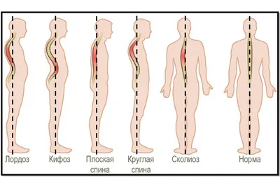 INTRAROS CO., LTD - Лечение искривления позвоночника Когда искривляется  позвоночник, то при этом изменяется не только внешний вид, но и начинаются  проблемы с работой лёгких и сердца. Если врач констатировал такое  заболевание,