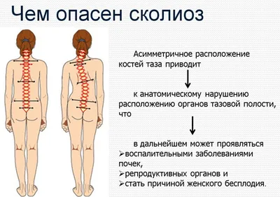 К чему приводит грыжа позвоночника поясничного отдела. Доктор Позвонков