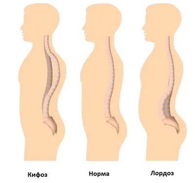 Как лечить искривление позвоночника у детей — блог медицинского центра ОН  Клиник