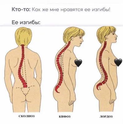 Искривление позвоночника | берут ли в армию с искривлением позвоночника?