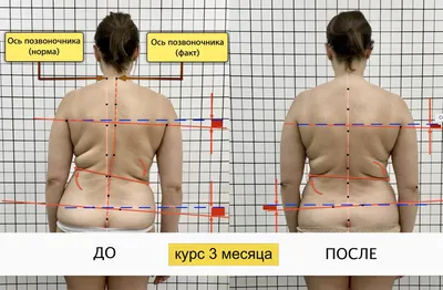 кифоз. мужчина страдает от искривления позвоночника в верхней части. шейный  позвонок вырывается и образует горб. Стоковое Фото - изображение  насчитывающей корчи, уродство: 217368804