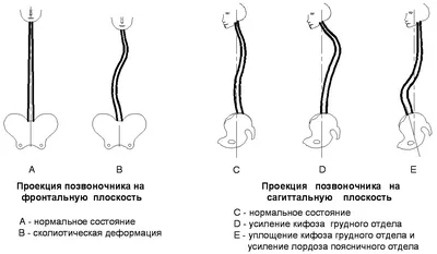 Искривление грудного отдела позвоночника: что делать?