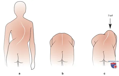 https://imin.clinic/blog/iskrivlenie-pozvonochnika-skolioz-u-detey/