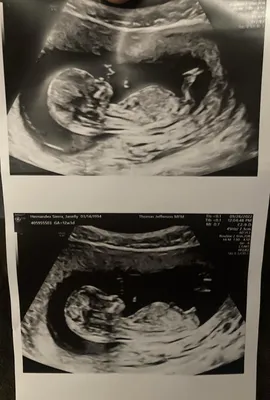 12 weeks ultrasound. What do you guys think??? Boy or girl? My first baby  🥹🫶🏽 : r/nubtheory