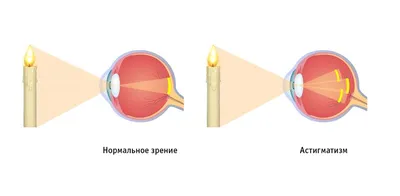 Каково это — быть альбиносом - Афиша Daily