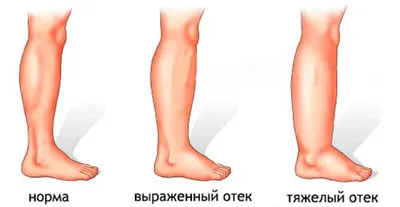 Отеки стопы ног - причины | почему опухают ноги