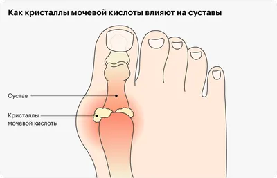 Подагра что это за болезнь симптомы лечение диета — Наедине-Н