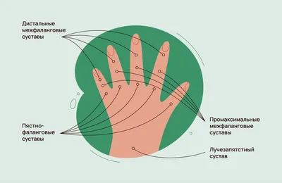 Подагра