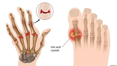 Подагра - симптомы, причины, лечение - Рамблер/доктор
