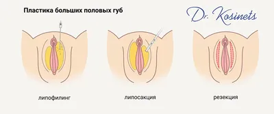 Реконструкция половых губ в Хабаровске - Медцентр Медикъ