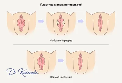 Киста половой губы: причины, симптомы, диагностика, лечение, операция в  клинике «АльтраВита»