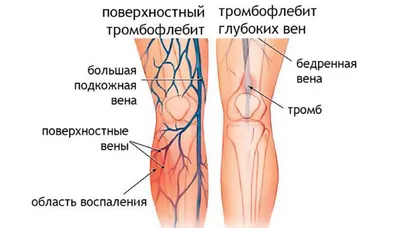 Как распознать тромбоз и тромбофлебит — блог медицинского центра ОН Клиник