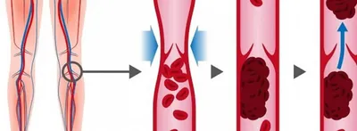 Чем отличаются варикоз, тромбоз и тромбофлебит