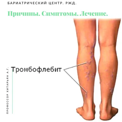 Лечение тромбофлебита вен в Харькове | МЦ в Da-vinci Clinic