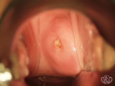 Atlas of visual inspection of the cervix with acetic acid for screening,  triage, and assessment for treatment