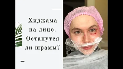 Хиджама: зачем мусульмане льют свою кровь | Батенька, да вы трансформер