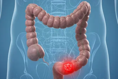 Рак кишечника: симптомы, признаки, диагностика и лечение