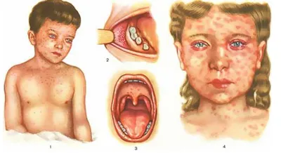 Корь - крайне заразная вирусная инфекция. Заболеть может как ребенок, так и  взрослый » Осинники, официальный сайт города