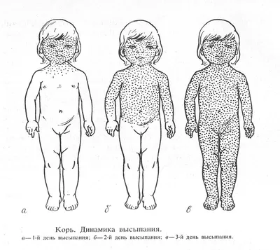 Корь не отступает: в Алматы нестабильная эпидемситуация